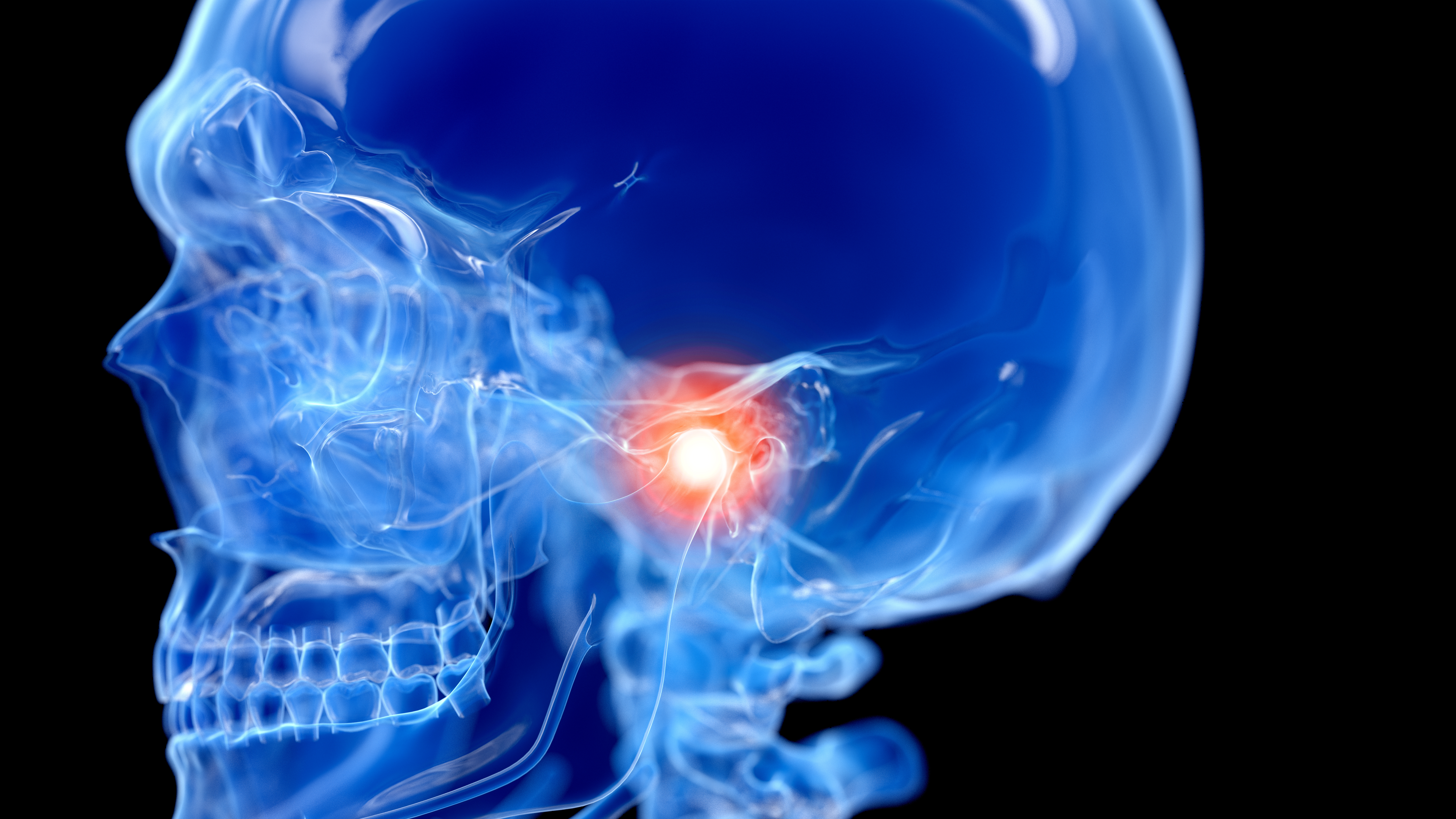 3d rendered illustration of a painful temporomandibular joint